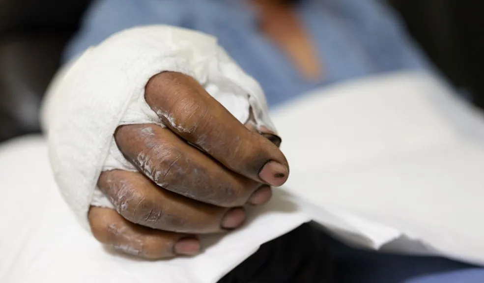 Aumentan los quemados por polvora en diciembre y Soacha lidera las cifras